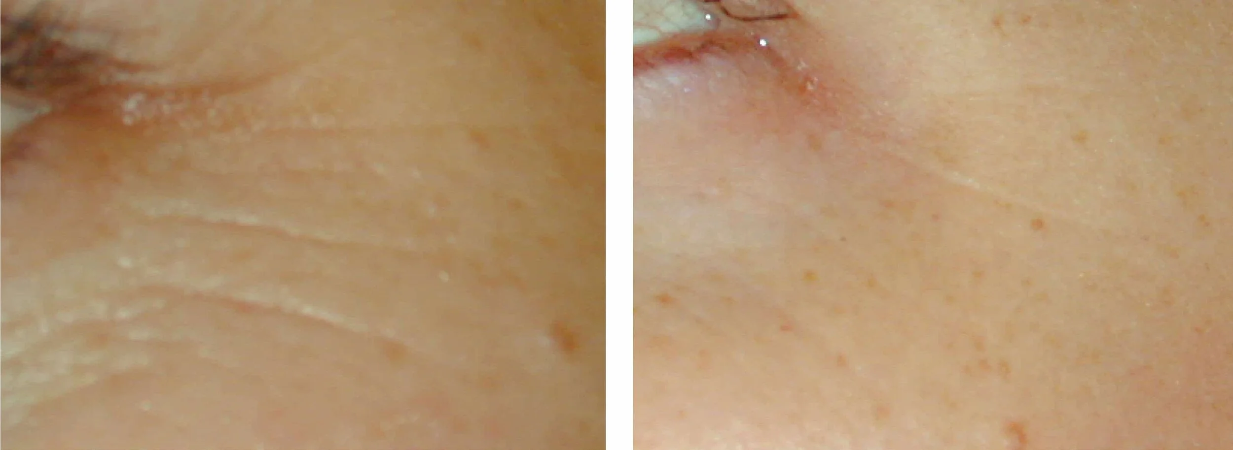 Laser Genesis Acne Treatment in Houston Artavi Med Spa — Artavi Med Spa