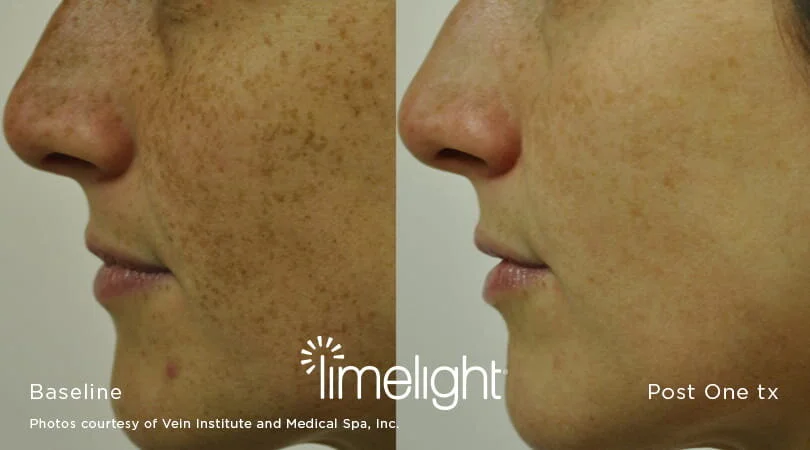 ipl photofacial