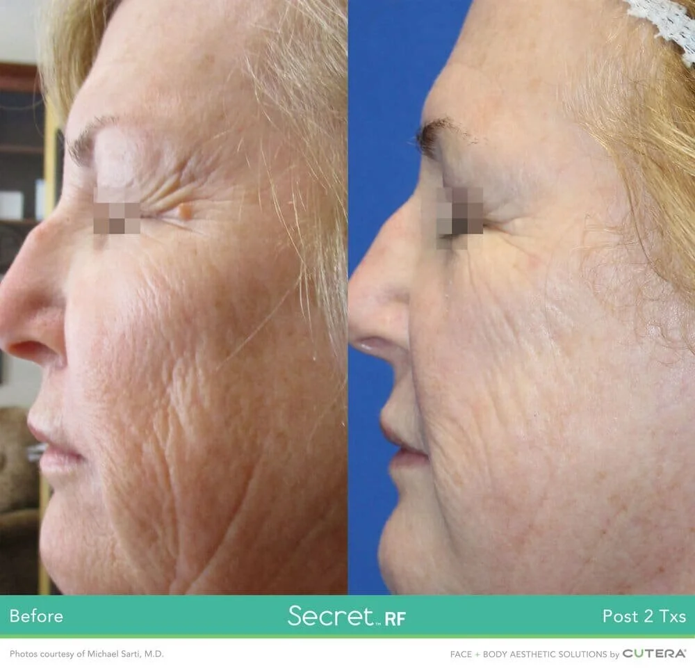 radiofrequency skin tightening near me