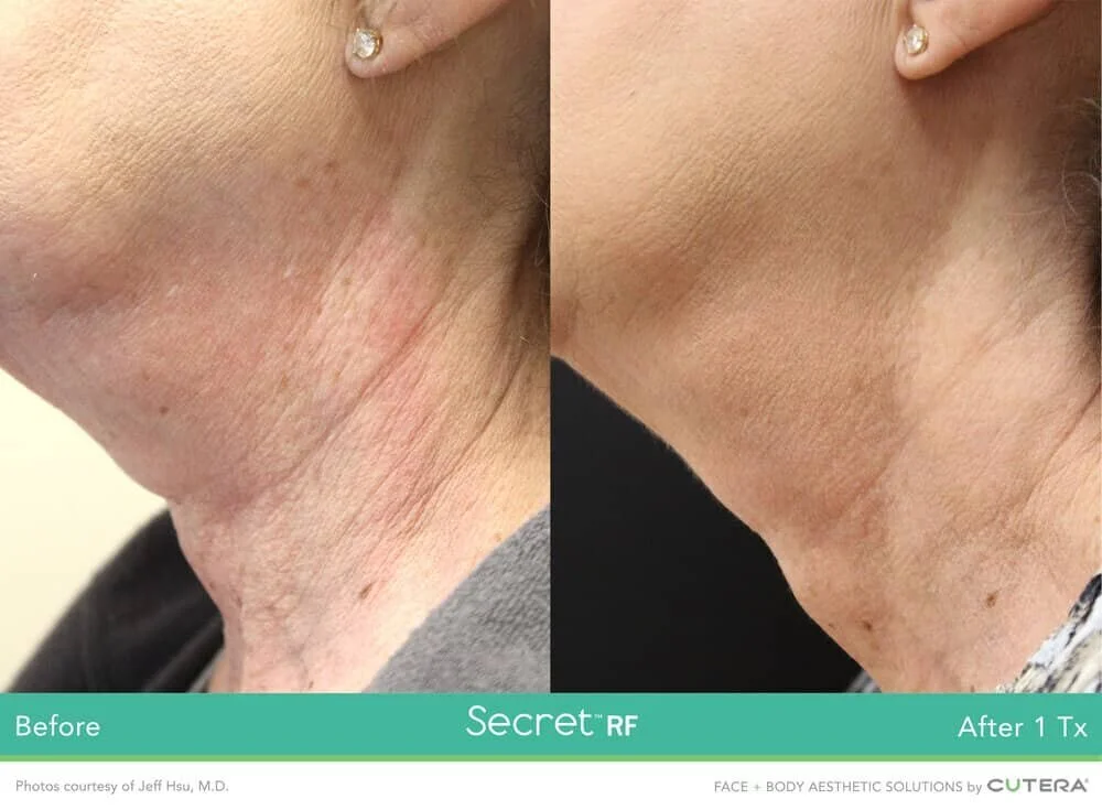 Skin Tightening with Secret RF in Houston Artavi Med Spa — Artavi Med Spa
