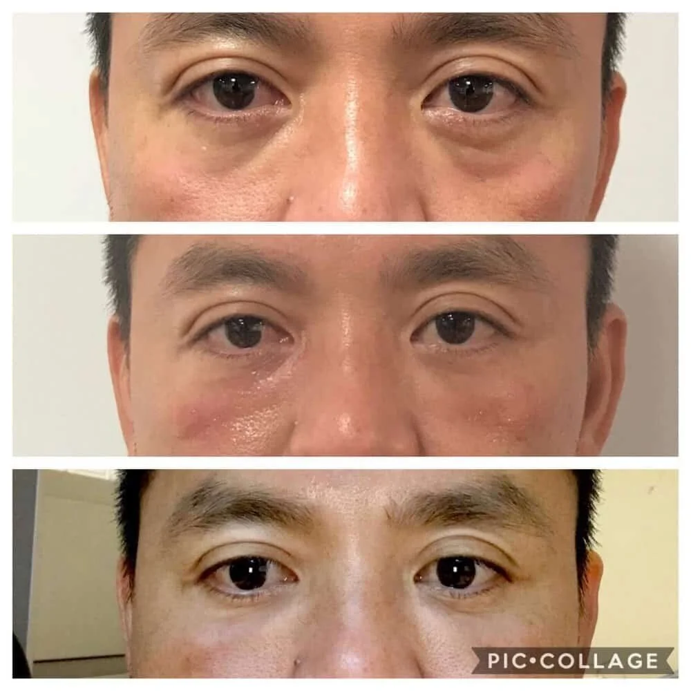 PRP Hair Restoration Treatment in Houston Artavi Med Spa — Artavi Med Spa