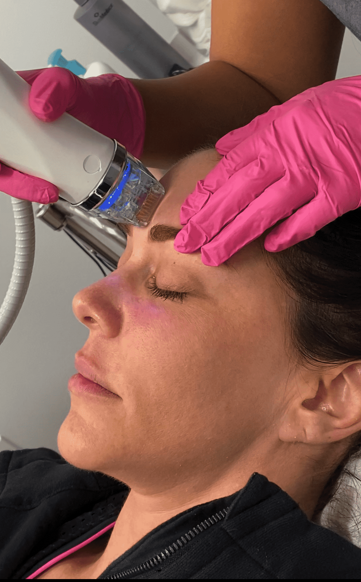 RF Microneedling