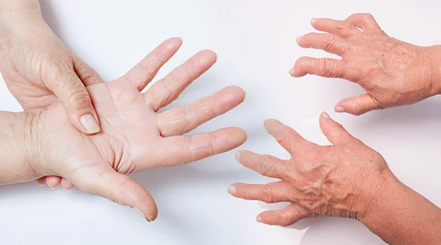 Rheumatoid-Arthritis-and-Cancer-Connection.jpg