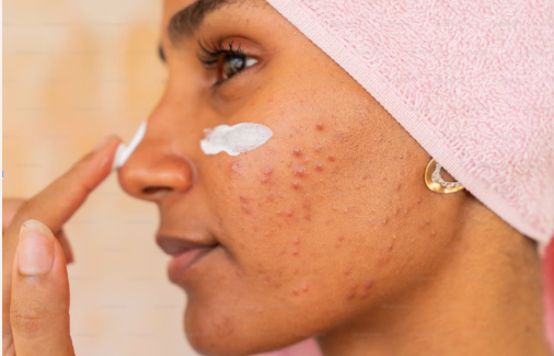 Acne: What Is It and How Do We Treat It? 
