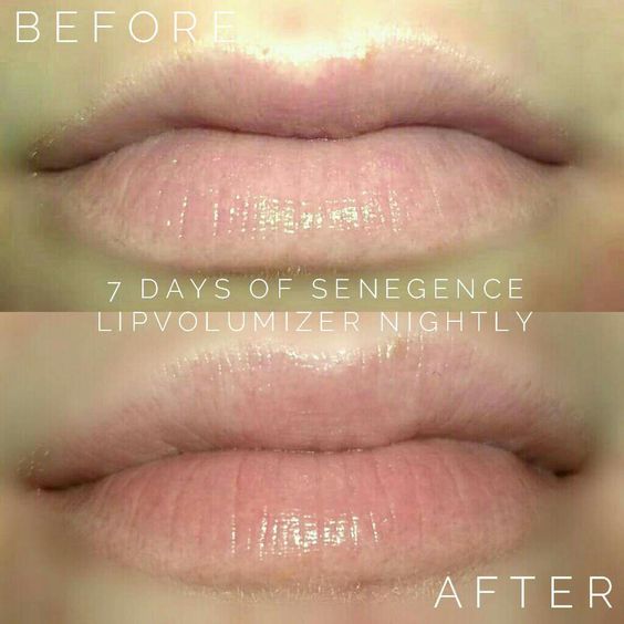 LipVolumizer Before and After Photo