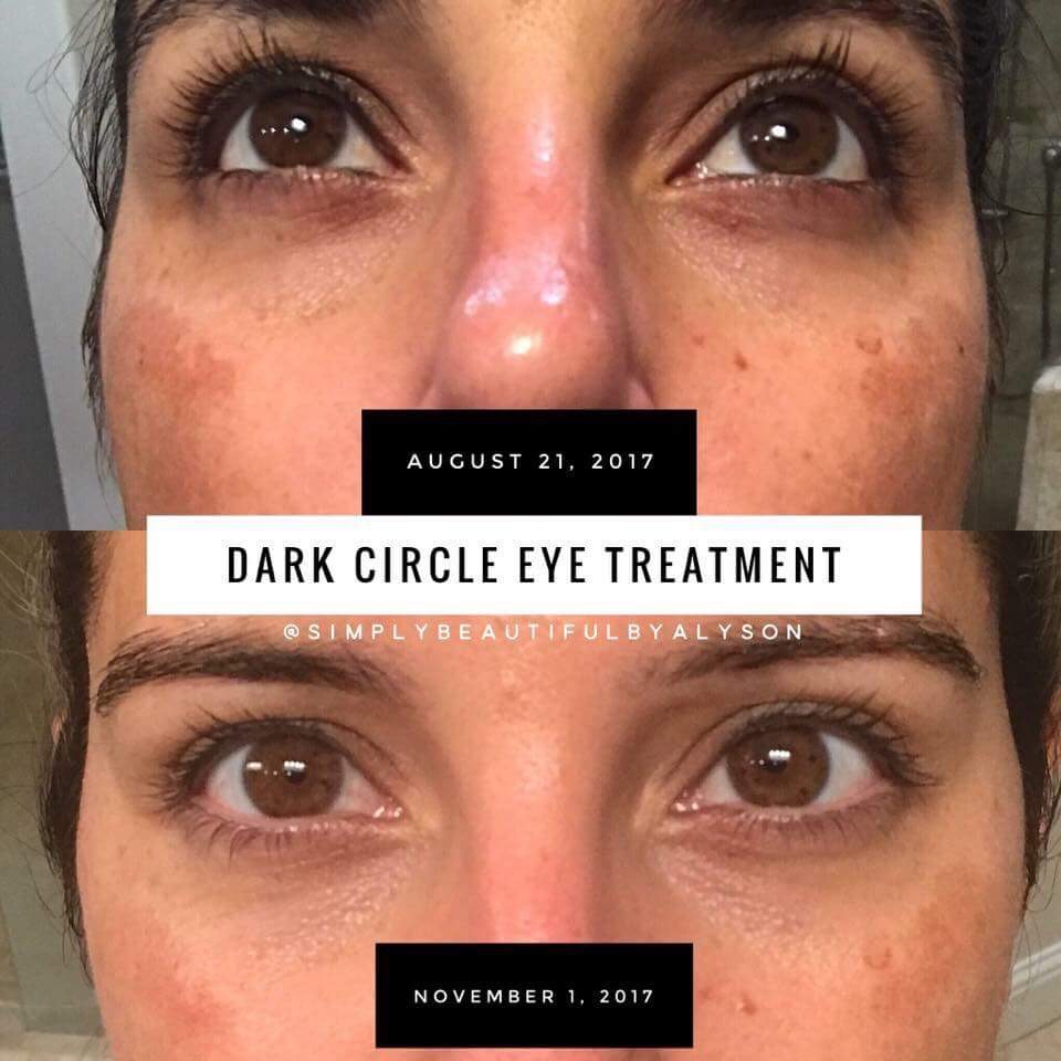 SeneDerm Solutions Dark Circle Eye Treatment Reviews