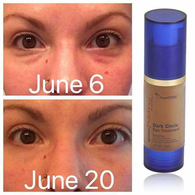 SeneDerm Solutions Dark Circle Eye Treatment Before and After