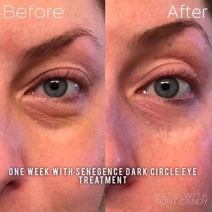 eyes dark circles before after