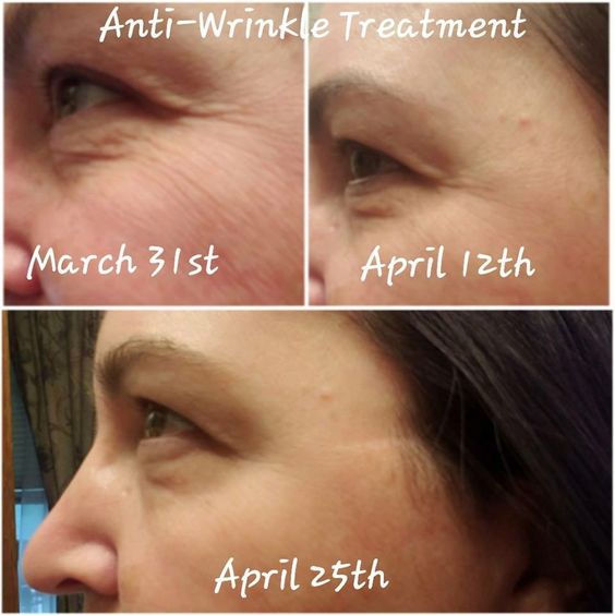 SeneGence Anti-Wrinkle Before and Afters