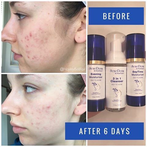 Spot-On Acne Treatment Before and After