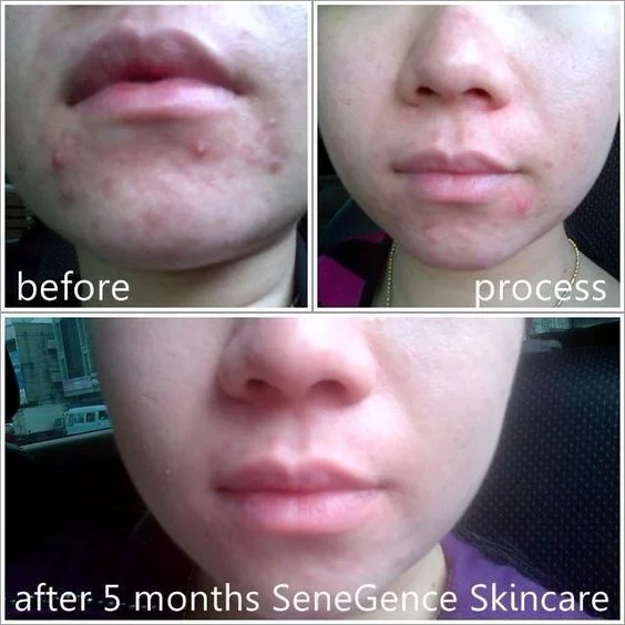 Spot-On Acne Treatment Before and After