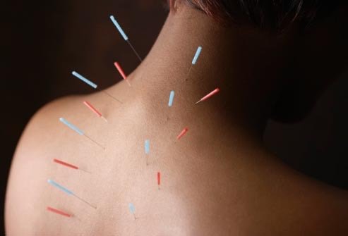 Acupuncture for Whole-Person Wellness
