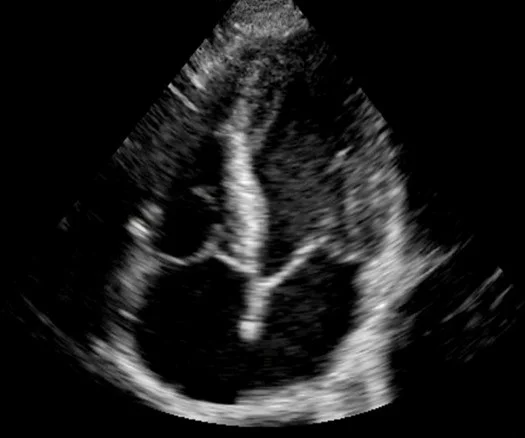 Ultrasound in Cardiac Arrest1. ResusTEE Collaborative (https://www.resuscitativetee.com/collaborative)2. Reason Trial 3 (Echocardiographic vs Electrocardiographic Findings in Cardiac Arrest)