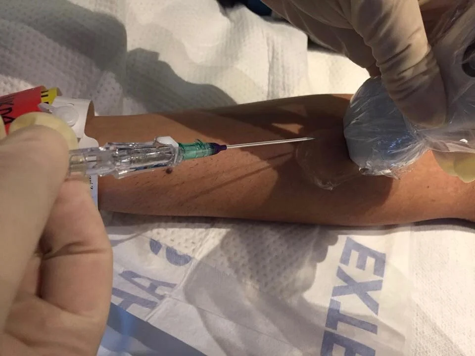 LA vs SA USGPIVs: A Randomized Control Trial