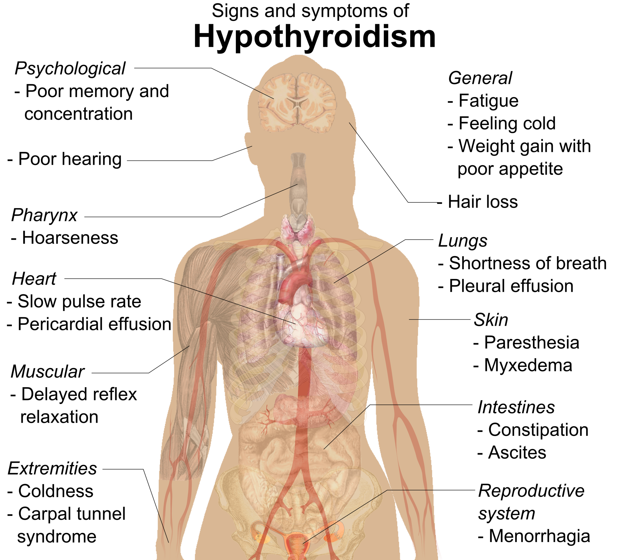 Häggström, Mikael (2014). " Medical gallery of Mikael Häggström 2014 ". WikiJournal of Medicine 1 (2). DOI : 10.15347/wjm/2014.008 . ISSN 2002-4436 . Public Domain .