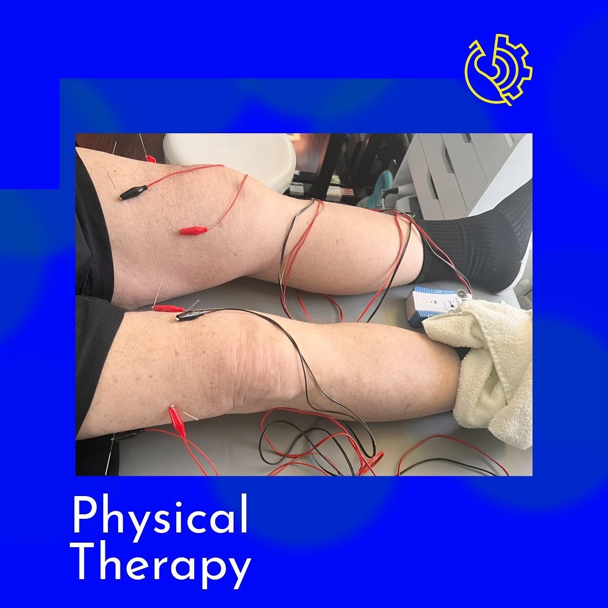 🦵 Dry needling case 2 weeks ago: bone on bone osteoarthritis, delaying knee replacement surgery as long as possible and steroid injections no longer effective. Came to me for help, dry needling w e-stim applied to quads one application, followed by 