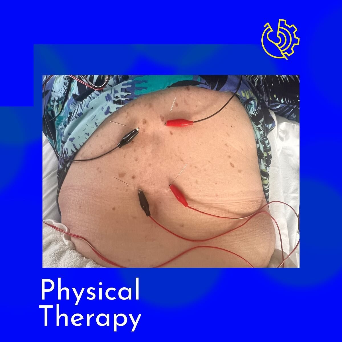 🪡 Dry needling with electrical stimulation for low back pain, can be an extremely effective modality in conjunction with the right kinds of movements to get through the acute phase of back pain more quickly than if left alone. 

  Muscle spasms that