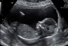 Oops! I'm pregnant...Nvr Mind