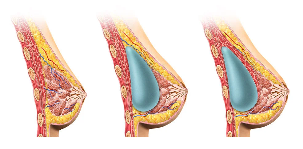 breastfeeding-with-implants-under-or-over-muscle-w.jpg