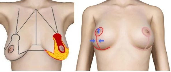 breast_lift_image_06.jpg