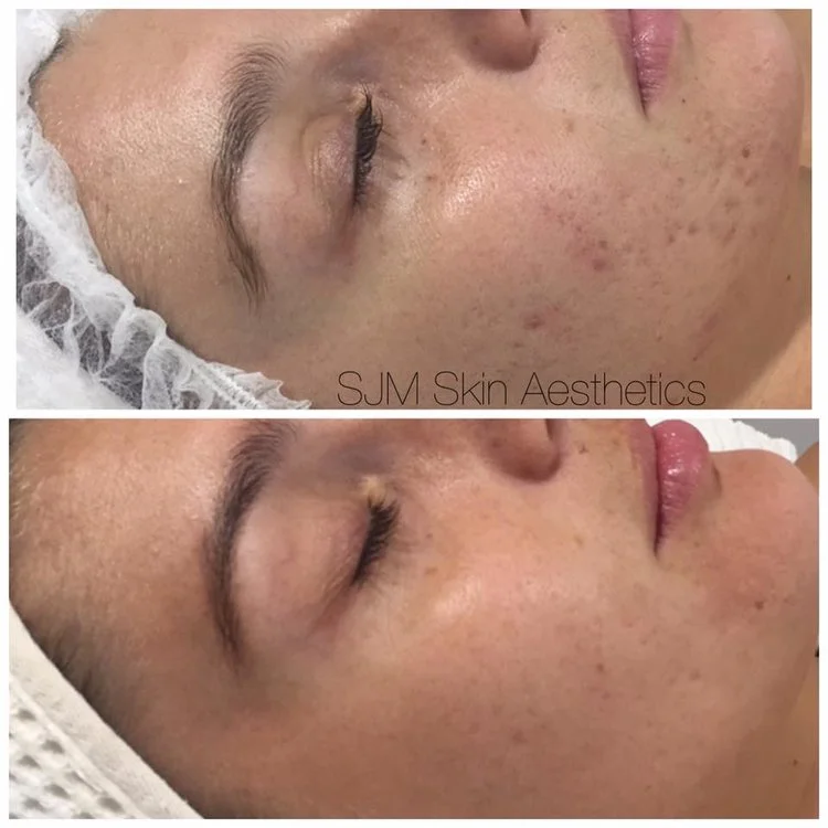 Treatments: 4x Enzyme Peel + LED add on , 1x full face IPL , 6x CIT Needling. Homecare: Total Cleansing Cream, Custom Blend High Classic Moisturiser, SPF 30 +.