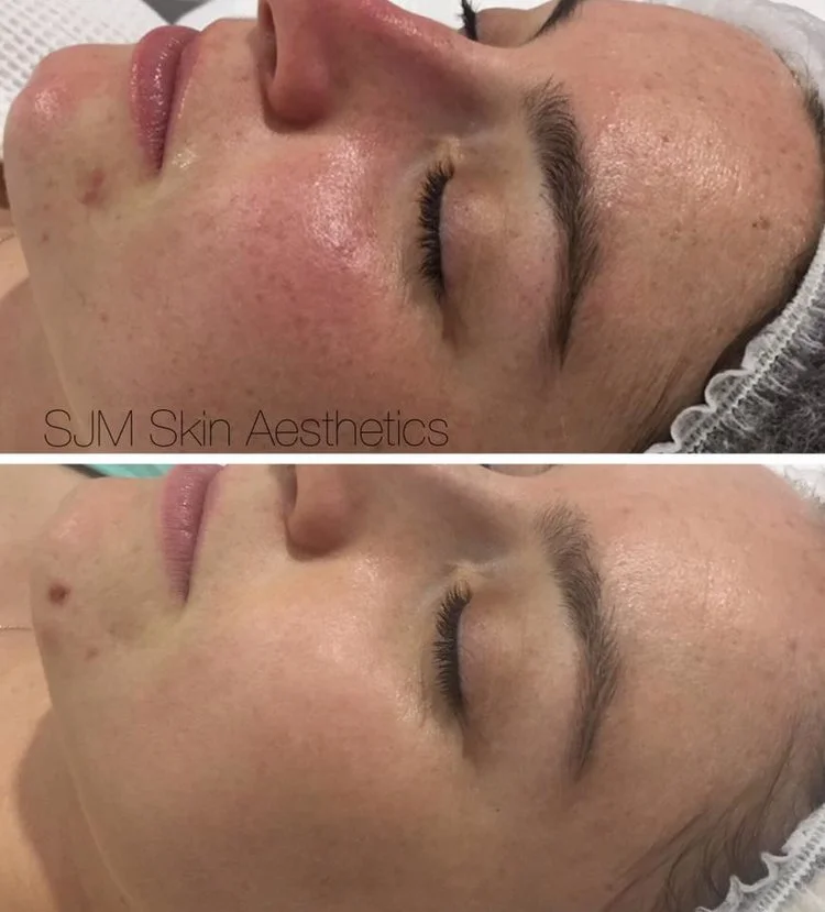 Treatments:6x Enzyme Peel + LED add on , 2x full face IPL , 1x CIT Needling. Homecare: Cleansing Milk with DMS, Lotion P, Lotion N, Custom Blend High Classic Plus Moisturiser, SPF 30+, MTS Home Roller.