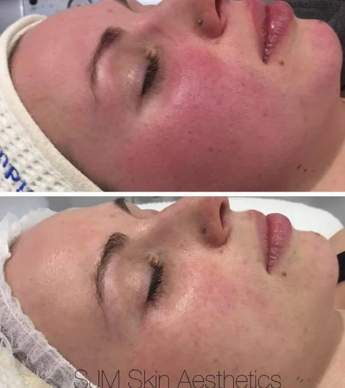 Treatments:4x Nutrition Facial + LED add on , 3x f ull face IPL , 1x CIT Needling . Homecare: Cleansing Milk with DMS, Lotion N, Custom Blend Serum, Oleogel R, Deco Foundation, MTS Home Roller.