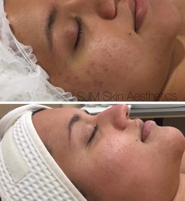 Treatments: 5x Nutrition Facial + LED add on, 1 x Enzyme Peel + LED add on , 4x CIT Needling . Homecare: Lotion N, Deco Foundation.