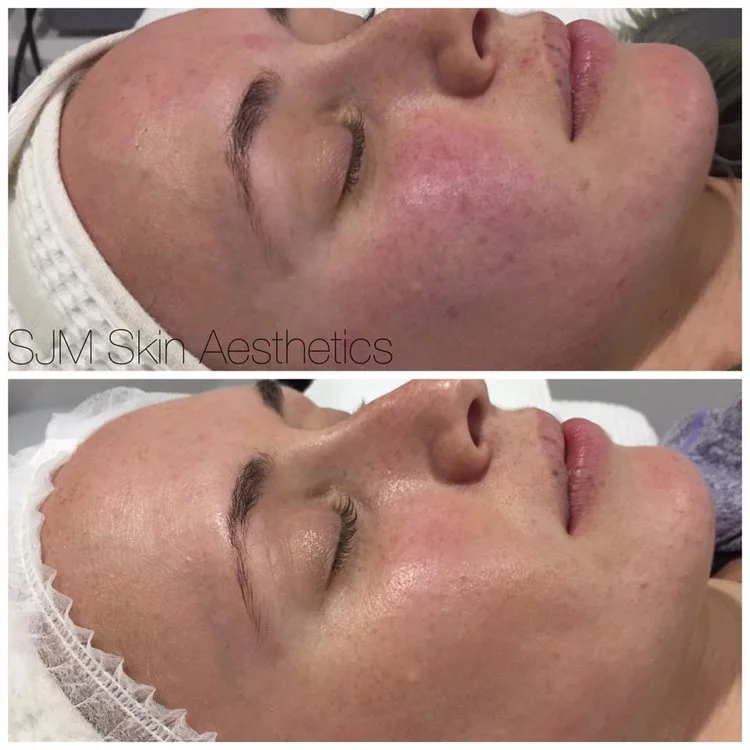 Treatments: 4x Nutrition Facial + LED, 1x full face IPL + 2x CIT Needling . Homecare: Total Cleansing Cream, Peeling Cream, Lotion N, Custom Blend Serum, DMS Base Cream High Classic Moisturiser, SPF 30 +, MTS Home Roller.