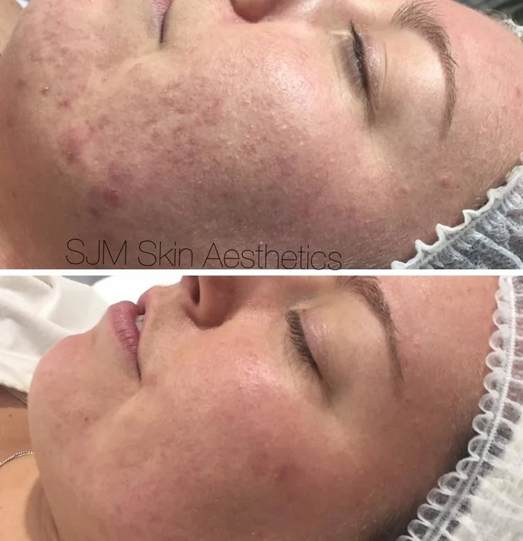 Treatments: 5x Enzyme Peel + LED add on, 7x CIT Needling + LED add on , 1x full face IPL + LED add on. Homecare: Total Cleansing Cream, Lotion P, Custom Blend Serum, Plutioderm Plus moisturiser.