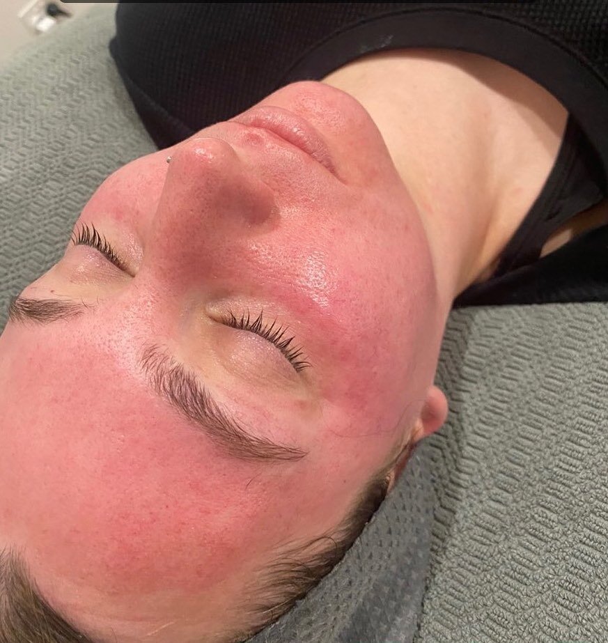 ⬆️Post skin needling flush

A efficacious treatment for so many skin concerns:

- Congestion
- Acne Scarring
- Other injury/trauma scarring improvement
- Reducing Fine lines &amp; wrinkles
- Reducing the appearance of sun spots/age spots
- Collagen p