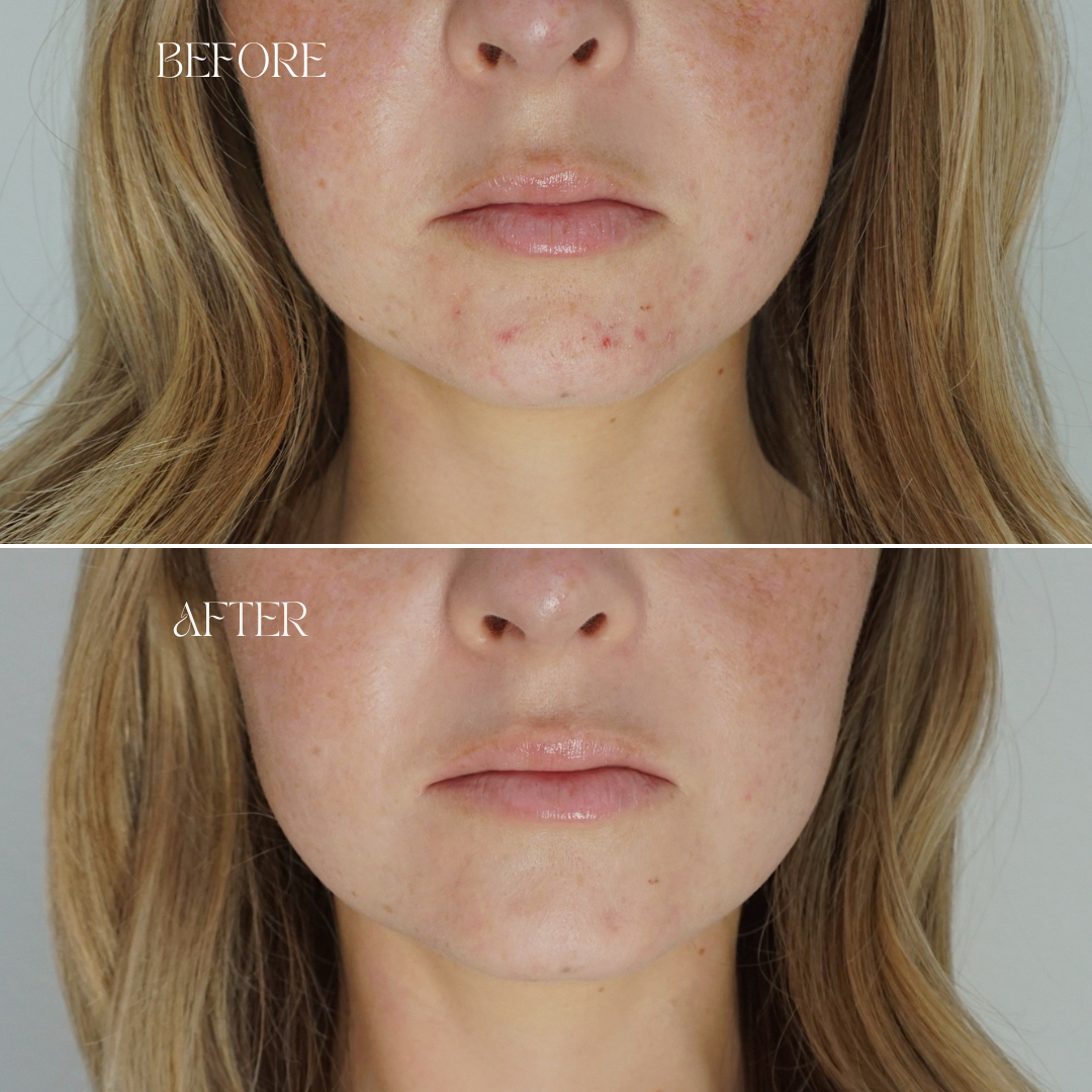 Curated visual reference: Best Acne Treatments For Sensitive Skin In The Caribbean Reference: Best Acne Skincare Routine For Dry Sensitive Skin