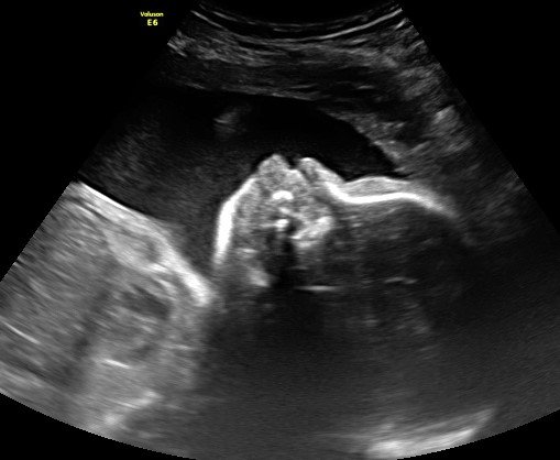 Gray Ultrasound Photo Album - My Baby's Heartbeat Bear