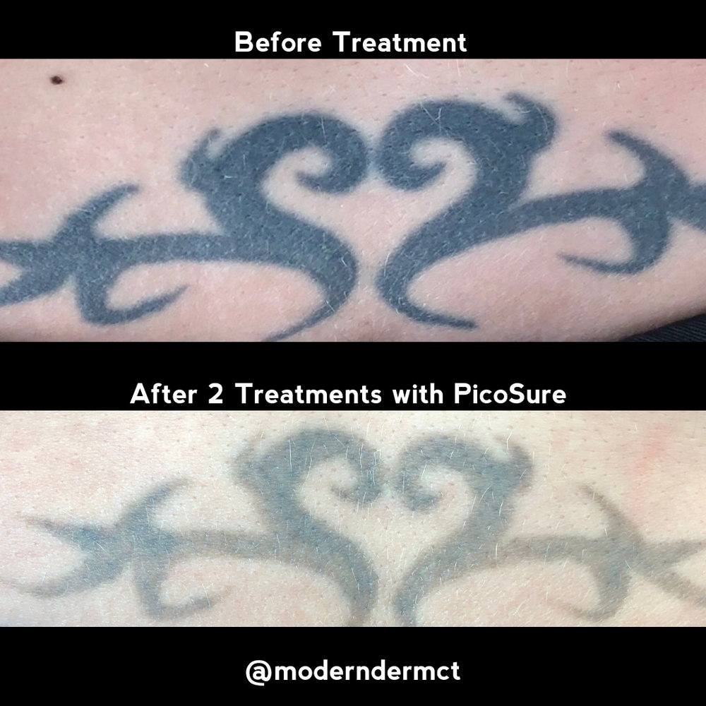 Ink Regret — Modern Dermatology of Connecticut