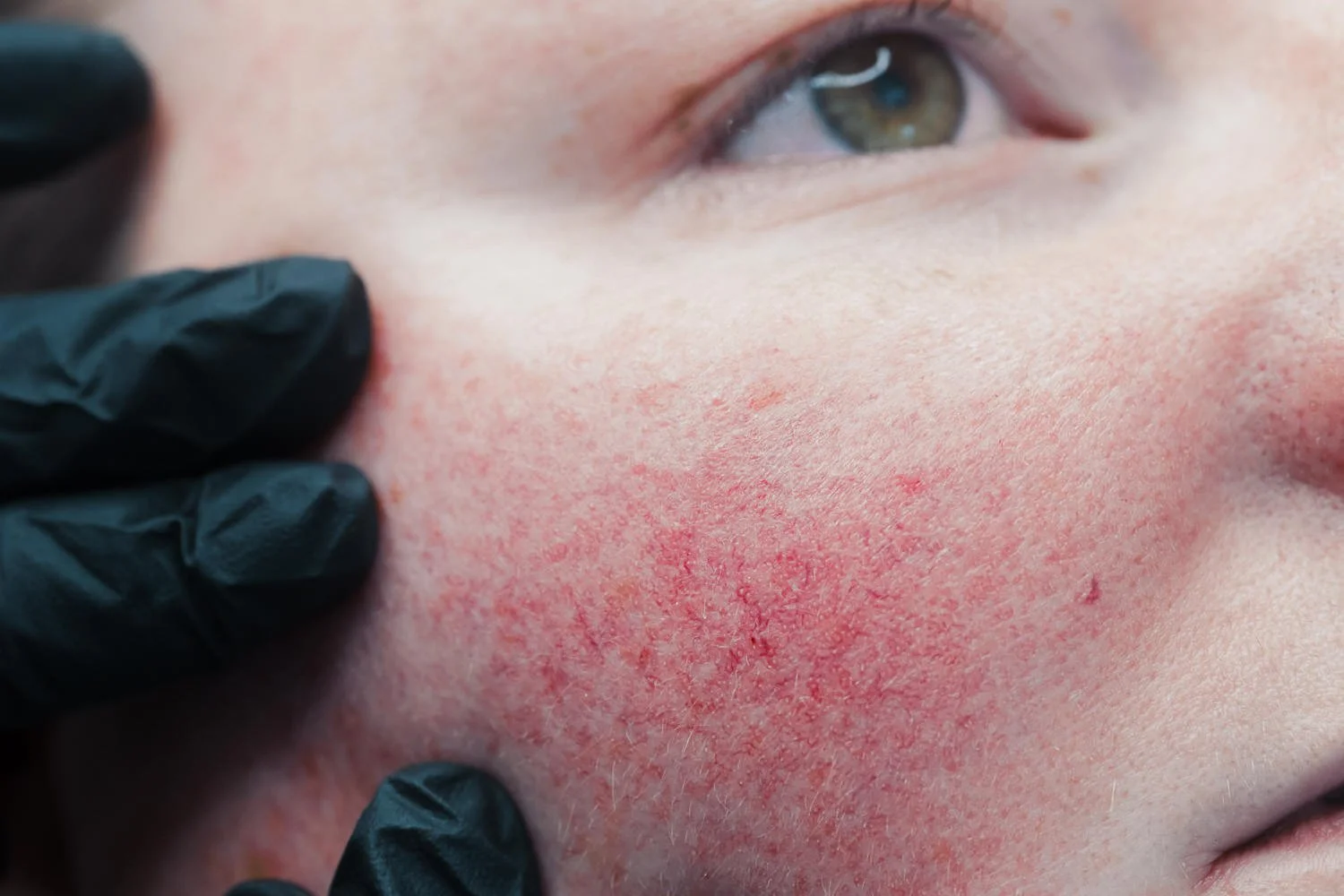 Laser treatment, close-up