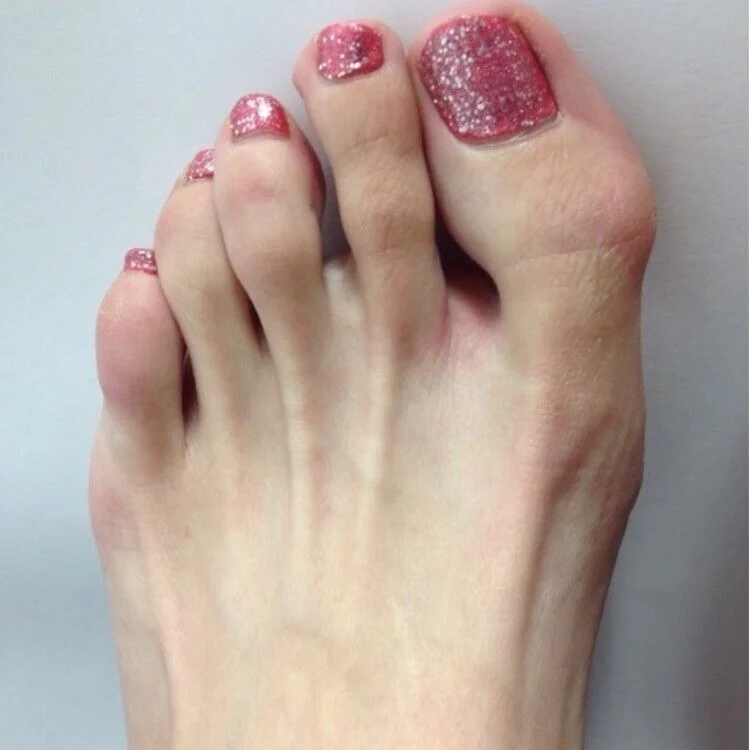 Bunion.2.jpeg