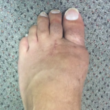 bunion.gallery.6.png
