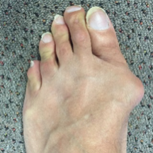 bunion.gallery.5.png