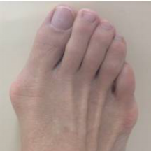 bunion.gallery.9.png