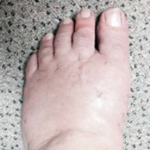 bunion.gallery.14.png