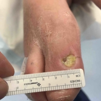 Diabetic Foot Ulcer Pre-Op