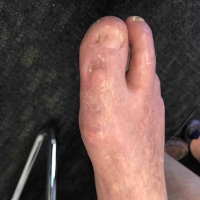 Diabetic Foot Ulcer Post-Op
