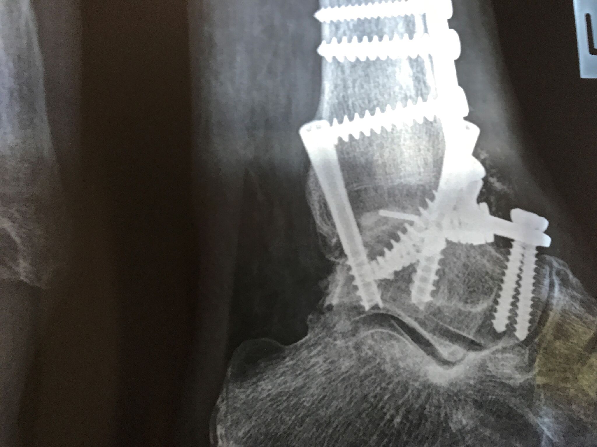 Ankle Fusion Xray after anterior plating and early rehab_preview.jpeg