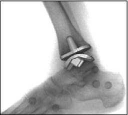 ankle replacement.1.png