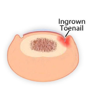 ingrown.toenail.png