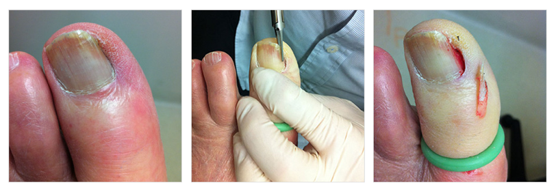 IJERPH | Free Full-Text | A Minimally-Invasive, Simple, Rapid, and  Effective Surgical Technique for the Treatment of Ingrown Toenails: A  Reminder of the Original Winograd Procedure