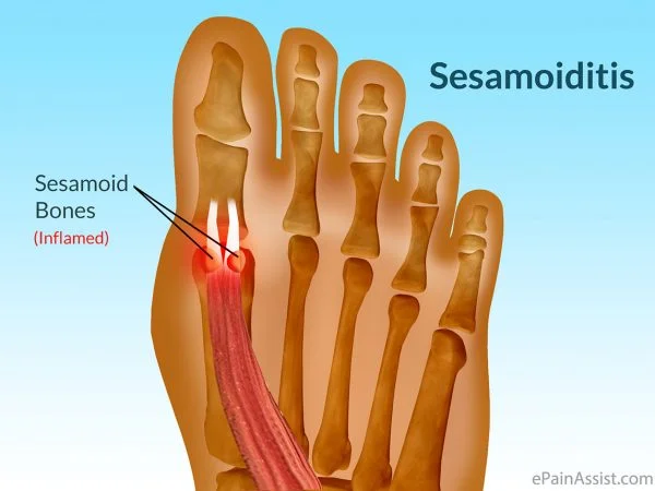 Sesamoid Bones.jpg