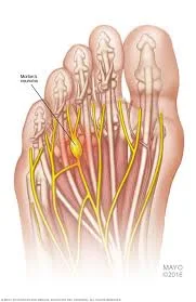 Morton's Neuroma.jpg