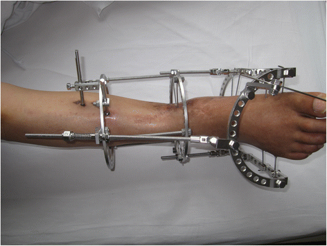 Distraction Arthroplasty.gif