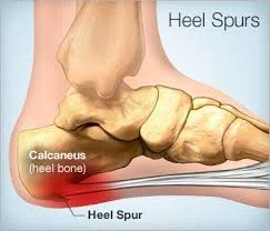 Heel Spurs - WebMD.jpg